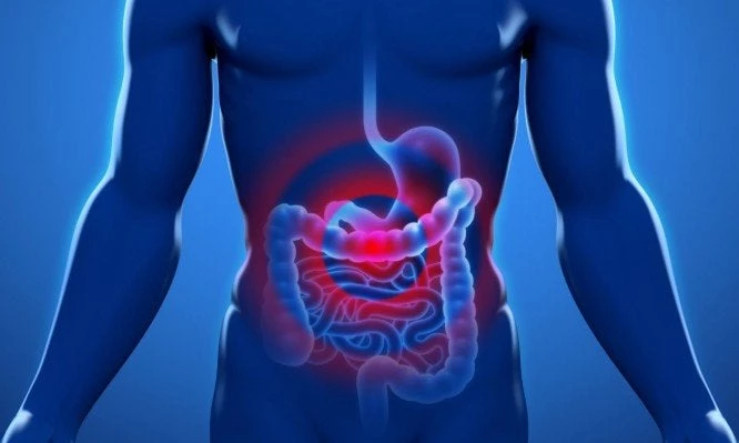 Καρκίνος του παχέος εντέρου: Τα συμπτώματα θυμίζουν τροφική δυσανεξία